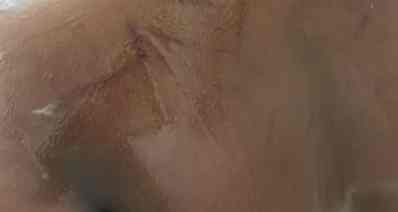 הגב של נועם עם סימנים כחולים. צילום: המשפחה