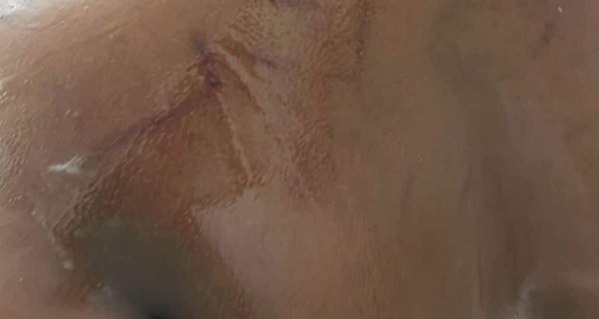 הגב של נועם עם סימנים כחולים. צילום: המשפחה